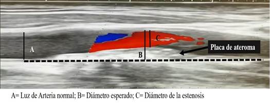 C:\Users\Nafxiel Brito\Documents\Proceso publicar\Dixon castro\fig. 1. Método de medición el porcentaje de oclusión de la arteria carótida..jpg